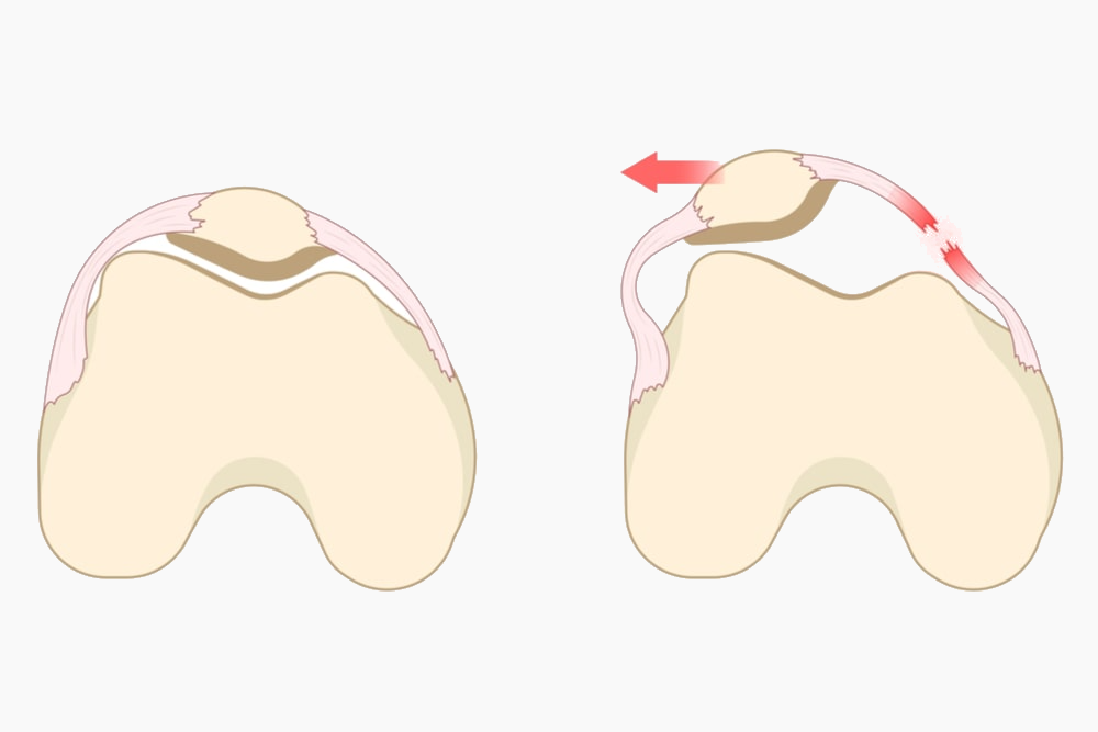 Patella Dislocation Surgery | Rockwall, TX | Manoj Reddy